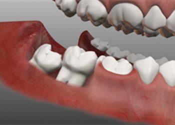 Cẩm nang những biện pháp hạn chế cơn đau do răng khôn