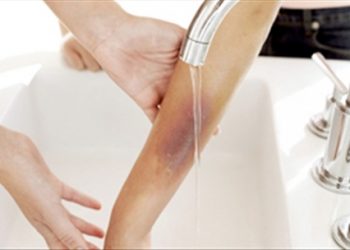 Cách đơn giản giúp con thoát khỏi đau đớn khi bị bỏng