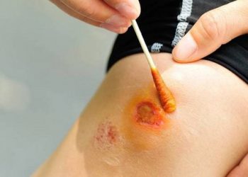 Nguy hiểm từ việc ăn cua ghẹ khi có vết thương chảy máu, hay làm thẩm mỹ, nâng ngực