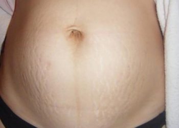Khắc phục vết rạn da xấu xí hiệu quả chỉ bằng quả trứng và chanh