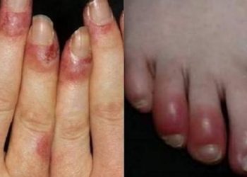 Một vài mẹo hay trị CƯỚC CHÂN TAY nhanh khỏi trong thời tiết lạnh