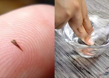 Mẹo lấy dằm ra khỏi tay đơn giản mà không phải cắn răng chịu đau