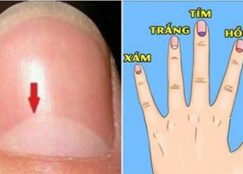 Chuẩn đoán tình hình sức khỏe của bạn qua móng tay