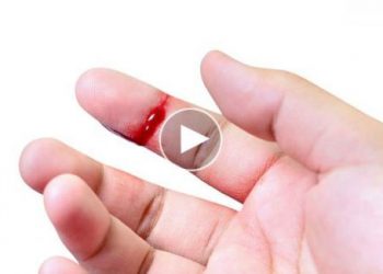 Cách băng bó vết thương ở tay