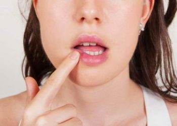 Cách giúp cho loét miệng hồi phục nhanh ít ai biết đến