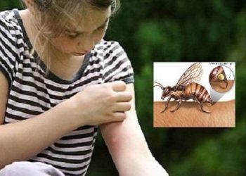 Cách xử lý vết côn trùng đốt để giảm nguy cơ nhiễm khuẩn