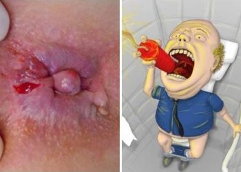 Điều trị bệnh trĩ ngoại bằng những bài thuốc dân gian