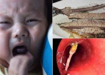 Mách các mẹ cách chữa hóc xương cá cho trẻ nhỏ cực kỳ hiệu quả