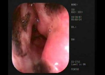 Dùng thảo dược hỗ trợ tiêu diệt vi khuẩn HP