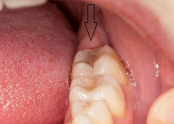 Mẹo siêu lợi hại giúp răng tự mọc trở lại mà không cần trồng răng giả hay hàn răng cực khổ