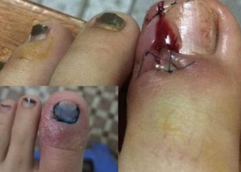 Bỏ ngay sở thích cắt khoé móng chân, nếu không muốn 5 mũi khâu chân đau đớn như cô gái trẻ này