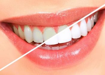 Hai cách lấy cao răng tại nhà an toàn bắt buộc phải nhớ