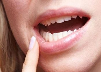 Bật mí cách điều trị nhiệt miệng nhanh chóng hiệu quả