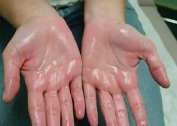 7 cách trị mồ hôi chân tay hiệu quả ngay và dễ dàng thực hiện