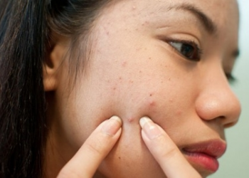 Vị trí mụn tố cáo bệnh nguy hiểm bạn không nên coi thường