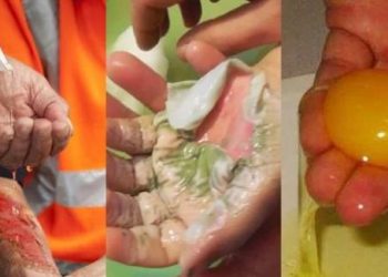 Sử dụng trứng gà để điều trị bỏng- Giải pháp đơn giản, an toàn