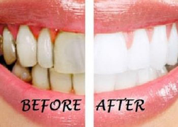 Cách làm răng trắng bóng nụ cười thêm duyên dáng, xinh xắn