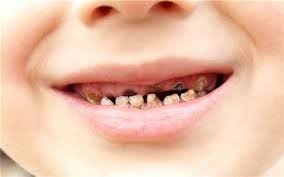 Phòng tránh sâu răng bằng các cách đơn giản ngay sau đây