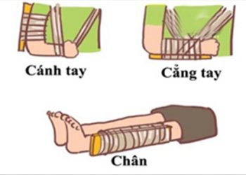 Cách sơ cứu khi bị gãy xương để xử lý sớm tránh biến chứng nguy hiểm