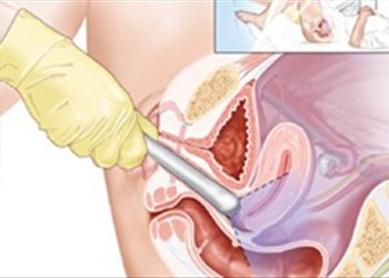 Mẹo hay để phát hiện sớm ung thư âm đạo các chị em nên biết