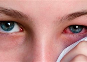 Lưu ý rửa mắt khi bị đau mắt đỏ để bệnh không thê nặng
