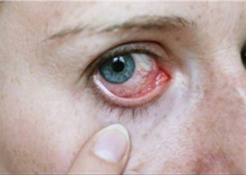 Mẹo chữa trị đau mắt đỏ hiệu quả bằng những biện pháp tự nhiên