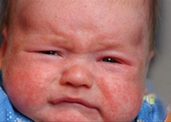 Mách nhỏ 4 tuyệt chiêu giúp bạn giảm ngứa do bệnh chàm