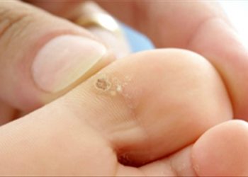 Mẹo hay đánh bay mụn cóc vô cùng hiệu quả bạn đừng bỏ qua