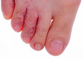 Mách bạn các cách trị nấm da chân hiệu quả ngay tại nhà