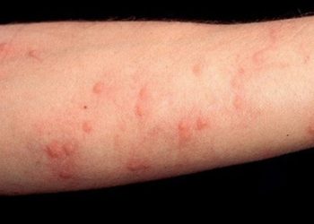 Học ngay một vài biện pháp để phòng ngừa nguy cơ nghiêm trọng xảy ra với cơ thể khi bị dị ứng