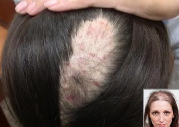 Tổng hợp các cách trị nấm da đầu hiệu quả nhất