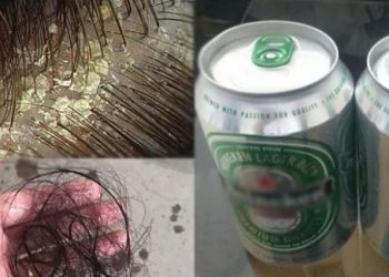 Bí quyết làm sạch gàu, ngăn ngừa tóc rụng bằng 1 lon bia