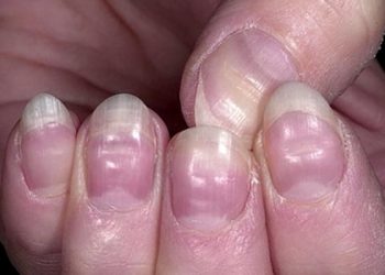 Mách bạn bí quyết nhìn móng tay đoán bệnh ít ai biết đến