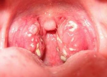Mách bạn mẹo ‘siêu tốc’ chữa đau, rát họng sau cổ vũ U23 Việt Nam chỉ nhờ gia vị trong nhà bếp
