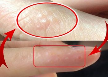 Đi tìm nguyên nhân và cách thức xử trí với mụn nước ở tay