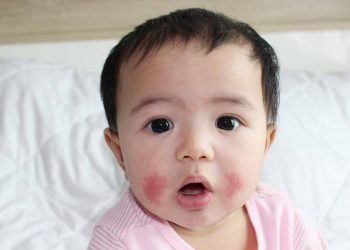 Viêm da cơ địa trẻ em – những điều cha mẹ nên biết
