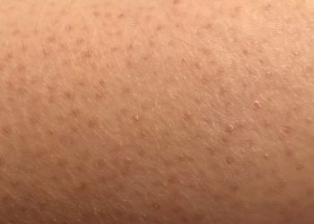 Dày sừng nang lông có thể chữa được không và chữa bằng cách nào?