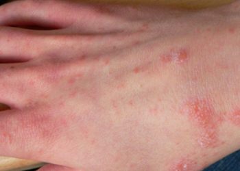 Ghẻ là bệnh gì và làm sao để nhanh khỏi?