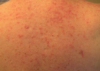 Bệnh viêm nang lông – nguyên nhân và cách điều trị hiệu quả