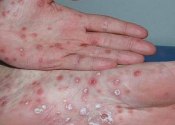 Những thông tin cơ bản về bệnh giang mai