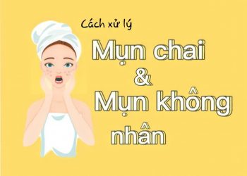 Mụn chai và mụn không nhân – loại mụn mà ai cũng có thể gặp phải