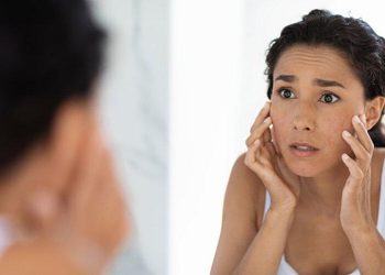 Cần phải lưu ý gì khi trang điểm trên làn da bị Eczema?
