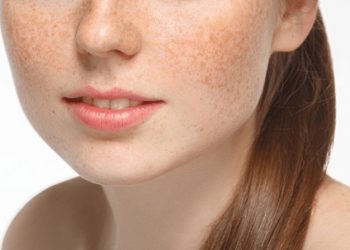 Điểm Danh Top 5 Sản Phẩm Trị Nám Tốt Nhất Hiện Nay