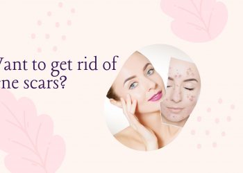 Lưu ngay cách trị sẹo rỗ sau mụn siêu hiệu quả bằng Tretinoin