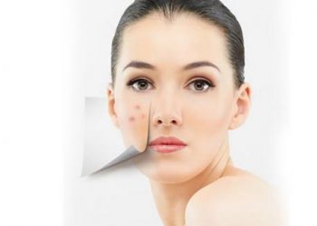 Mau áp dụng hai mẹo trị mụn trứng cá này để da sạch mụn nhé