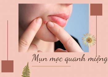 Vì sao mụn mọc quanh miệng? Bật mí cách giải quyết tối ưu cho bạn