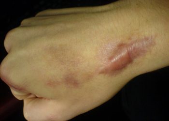 Tìm hiểu về các phương pháp trị sẹo lồi