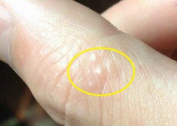 Bệnh ghẻ nước – nguyên nhân, dấu hiệu và cách thức điều trị tốt nhất