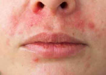 Tất tần tật mọi điều cần biết về bệnh viêm da quanh miệng