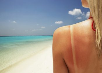 Bỏ túi ngay cách chữa cháy nắng để cứu cánh cho làn da trong mùa hè